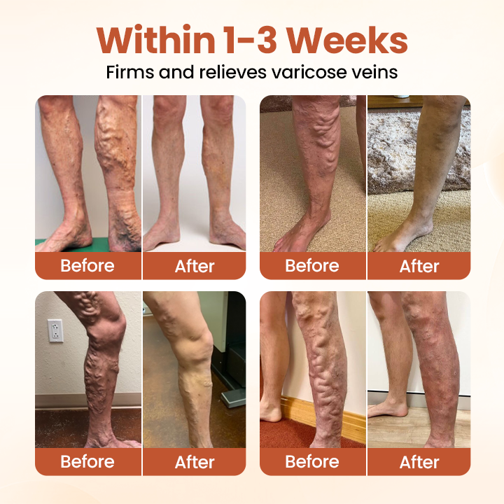 Timilk® VeinTarget Microneedle Patch⭐