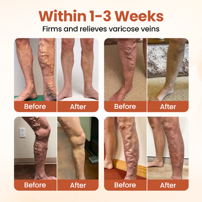 Timilk® VeinTarget Microneedle Patch⭐