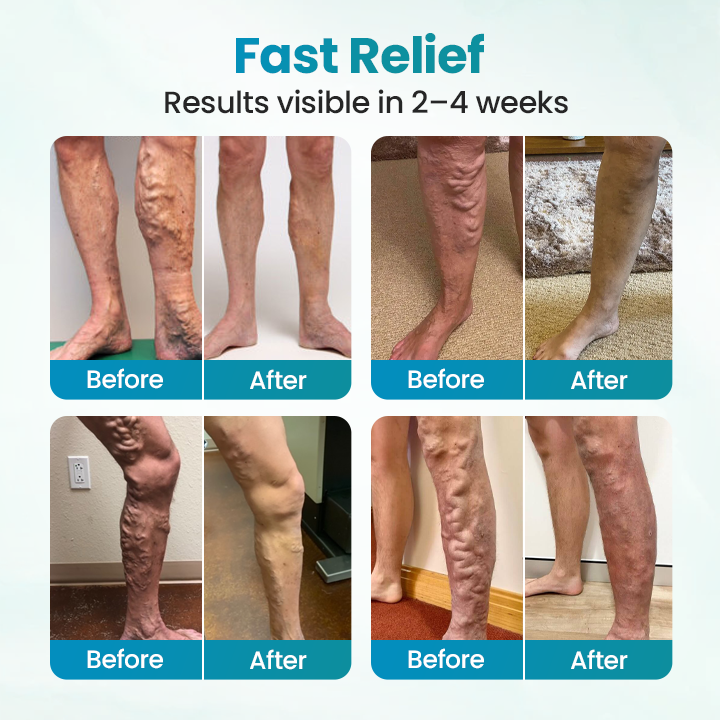 Timilk® VeinAway Relief Cream