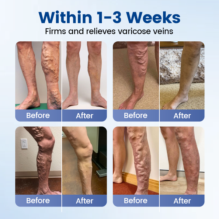 Timilk® Vein Ease Microneedle Therapy Patch - Fast ⚡Effective 💪 and Non-Invasive 🚫 Treatment for Varicose Veins & Leg Swelling 👣
