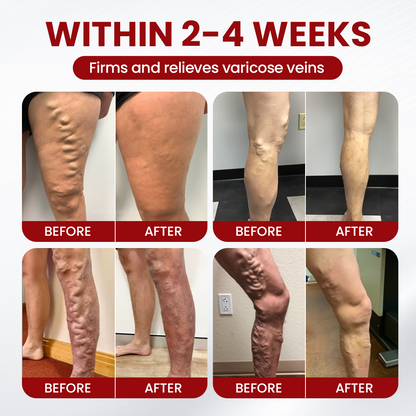 Timilk® Varicose Veins Cream