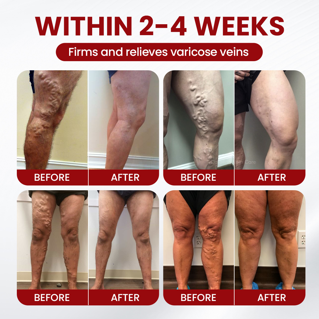 Timilk® Varicose Veins Cream