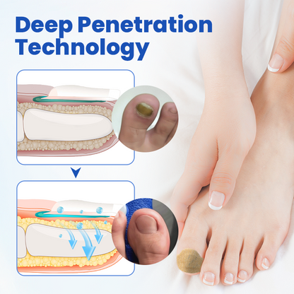 Timilk® FungalPatch - Antibacterial Fungal Patch