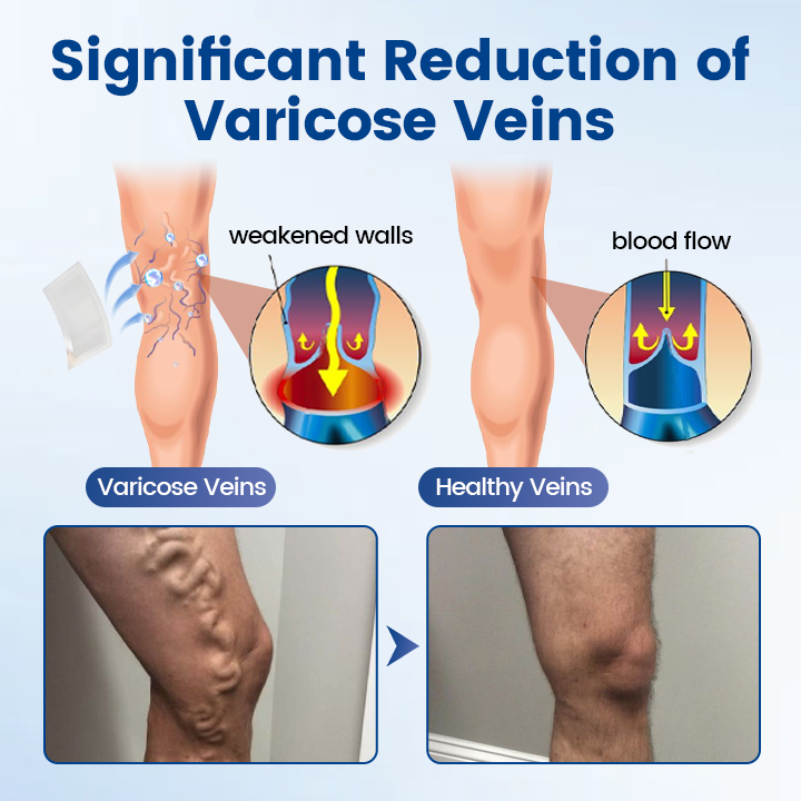 Timilk® Vein Ease Microneedle Therapy Patch - Fast ⚡Effective 💪 and Non-Invasive 🚫 Treatment for Varicose Veins & Leg Swelling 👣
